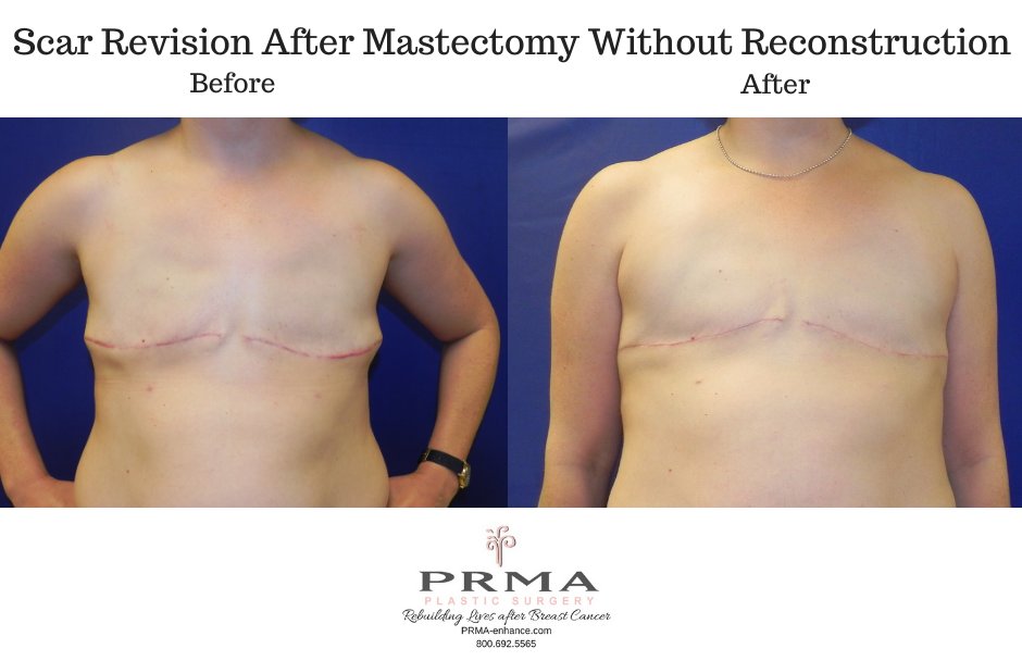 PRMA Plastic Surgery on X: #BreastReconstruction may not be for you, but  that doesn't mean you shouldn't discuss your options with a board-certified  plastic surgeon! Discussing flat closure & scar revision options