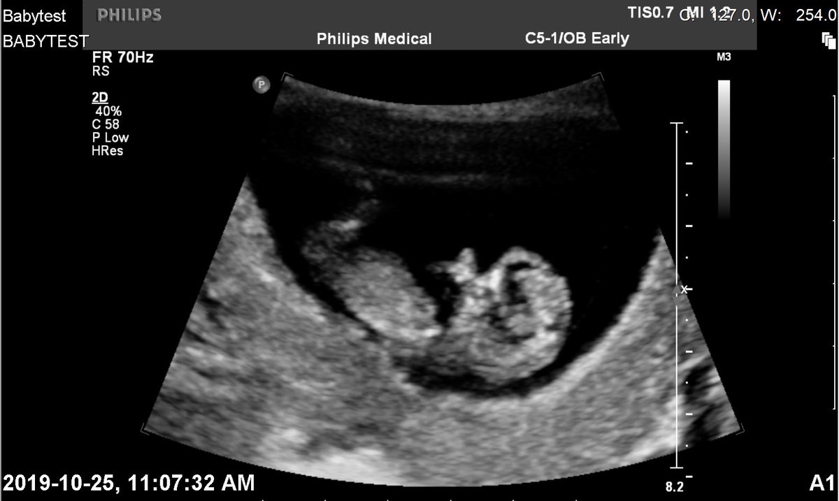AlaciaTimbit's tweet image. Baby Pic!!! May 14/2020!!!! Can't Wait!!! Baby Sucking Thumb!!!