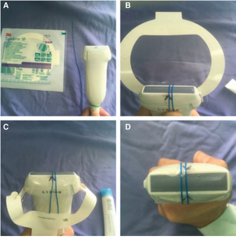 Acoustic Shadowing Facilitates Ultrasound-guided Radial Artery Cannulation in Young Children
ow.ly/OvKA50wRr4E
#PedsICU #PedsPain #PedsAnes
