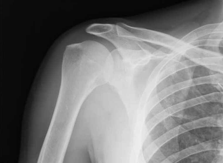 What do these symptoms mean?

#ShoulderPain and weakness, pain at night and at rest when lying on the affected shoulder, pain when raising, lowering and rotating the arm, popping or cracking sensation…

#ROTATORCUFFINJURY
medilink.us/aq2h