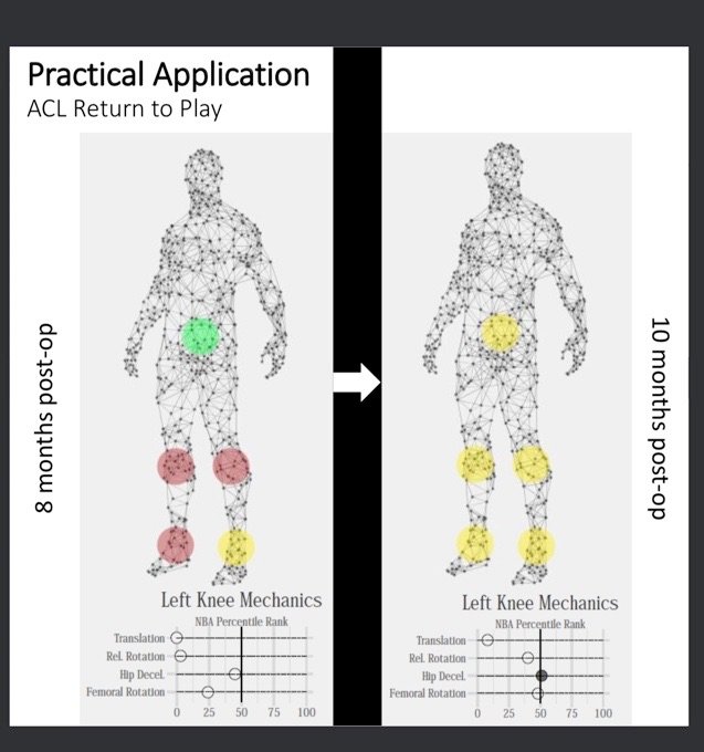 Visualization pertaining to an returning from left ACL rupture. In their first assessment post-injury, a number of variables linked to potential risk at the knee continued to exhibit considerable risk (despite being blinded to the athleteβs injury history).