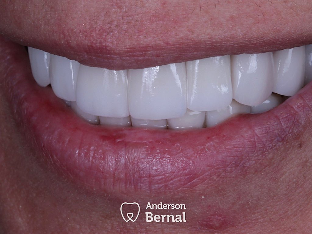 No Dia do Dentista, nd melhor do que...trabalhar. Paixão é pouco em cuidar da saúde bucal. Obrigado as centenas de msgs recebidas! Só energia boa..🤘❤️🤘🔝
E p fechar a semana, caso complexo reabilitador.
12 dentes em porcelana 3D, by <a href="/dentsplysirona/">Dentsply Sirona</a>, dentes em acordo com a face