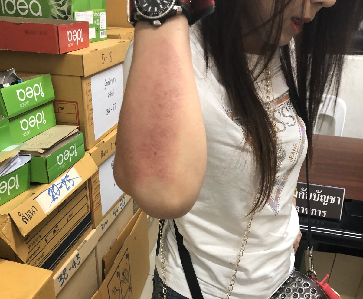 มีใครพบเจอผู้หญิงใส่แว่นเสื้อขาวแบบในรูประวังตัวด้วย คือนางบ้าแบบพูดจาว่าคนจะมาขู่ฟ้องร้องมันอะไรสักอย่าง แล้วก็เข้ามาทำร้ายร่างกาย เมื่อวานมันเข้ามาทำร้ายร่างกายน้องสาวเราทั้งๆที่ไม่รู้จักกันมาก่อนเลย เข้ามาจิกผมแล้วก็ต่อย แม่เราก็เข้ามาช่วย เกิดขึ้นแถวรามคำแหง-ลาดพร้าวค่ะ