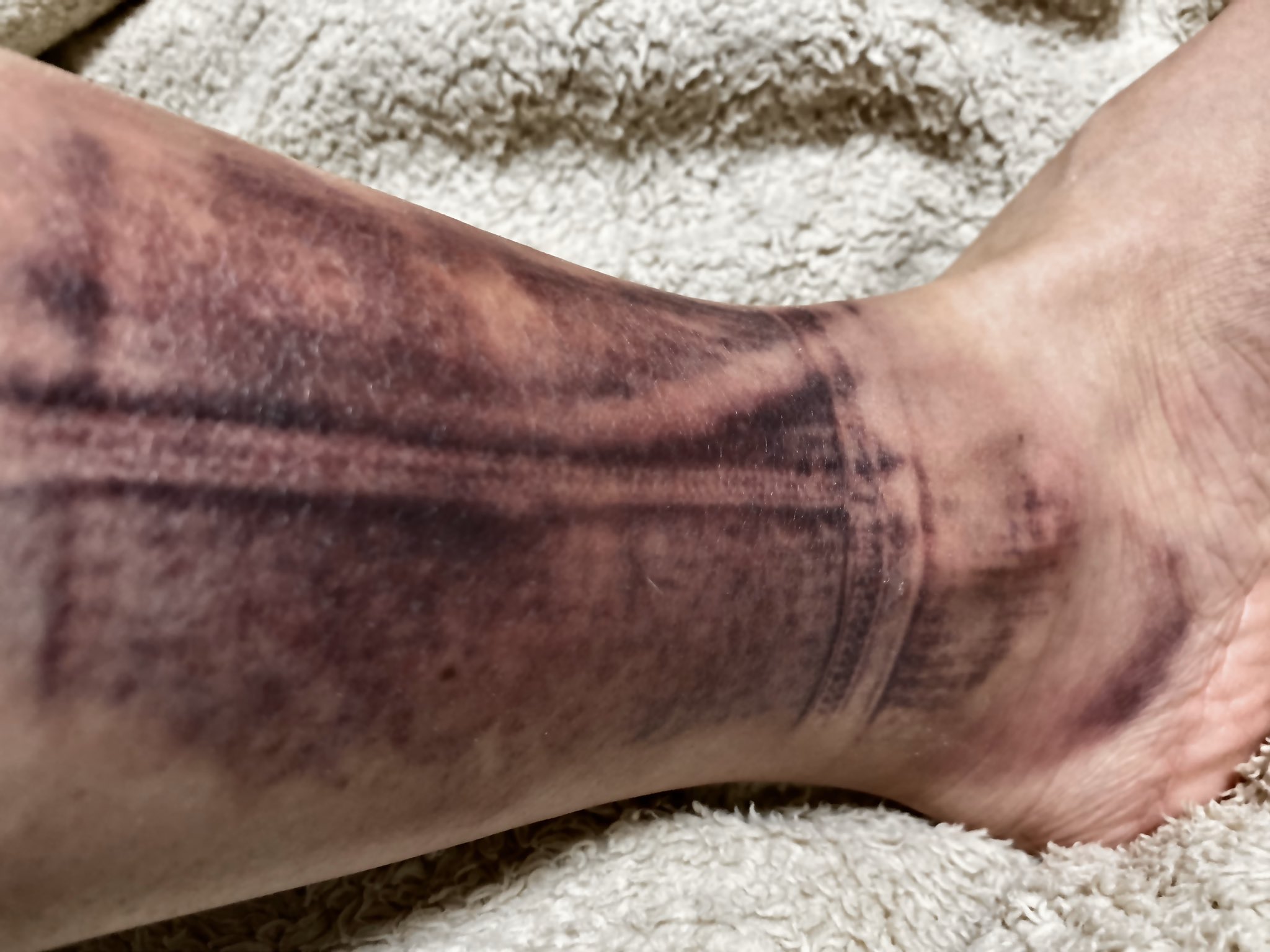 将 すね毛を剃らない男が多いけど すね毛は剃るだけで肌が綺麗に見えると伺ったからねげを剃ったら 肌質がアシタカの腕と同じだった T Co 5xks1exe2a Twitter