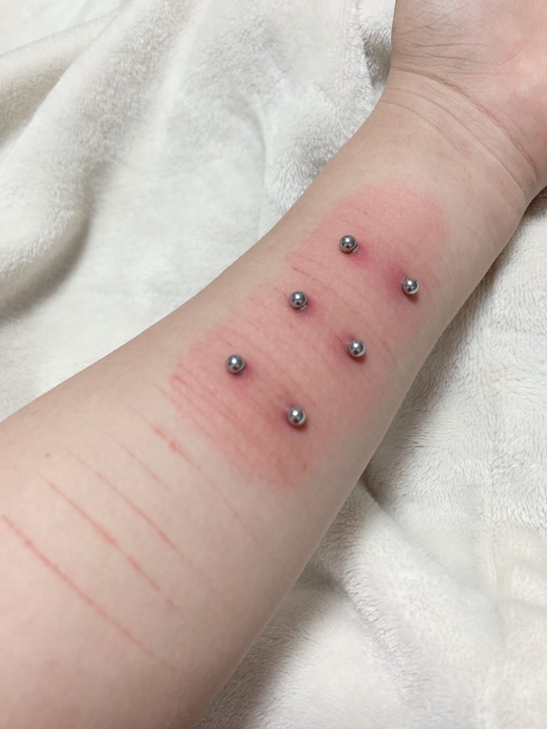 ゆきぽぽ リストピアスしてる人ー 開けてから1週間でこんなに赤く腫れたんだけど これは通常 それとも異常 これはもう外した方がいいですか 痛くないし腕は動くんだけど リストピアス 有識者募集 ピンチ 助けてください ピアス好きな人