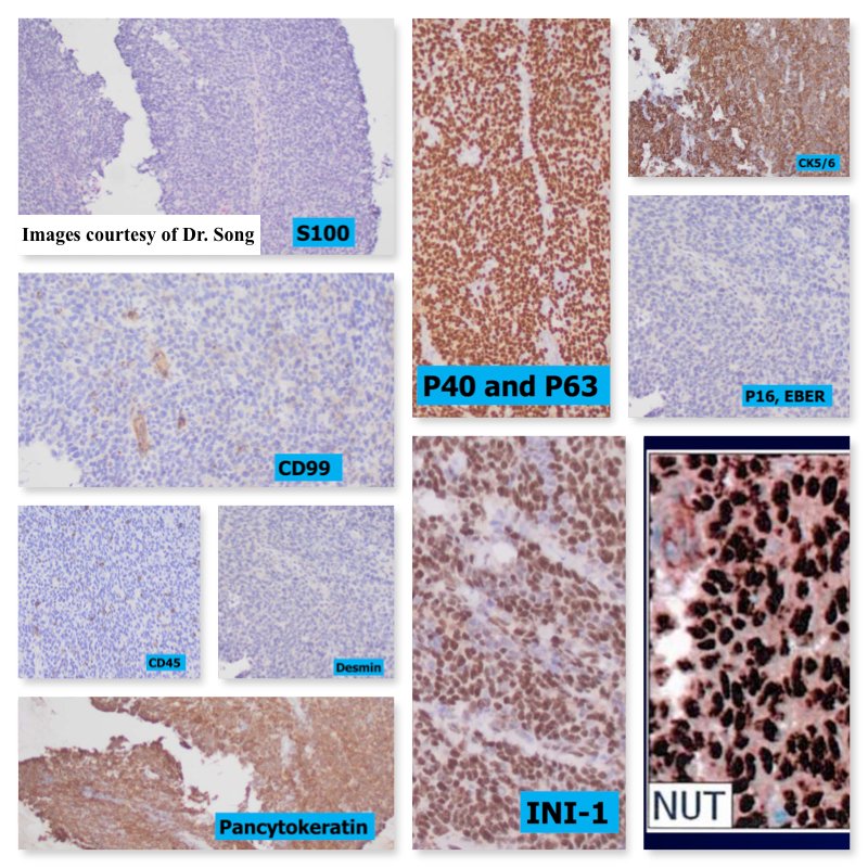 August meeting highlight: 14M w chest discomfort & SOB ➡️6cm lung mass w subcarinal adenopathy. Clinical concern for Coccidioides ➡️fluconazole w ⬆️discomfort
🔬NUT carcinoma!
📚BRD4-NUTM1+. Tx: Molebrisib (Bet inhibitor). Poor prognosis. Great case courtesy of Dr. Song #Lungpath