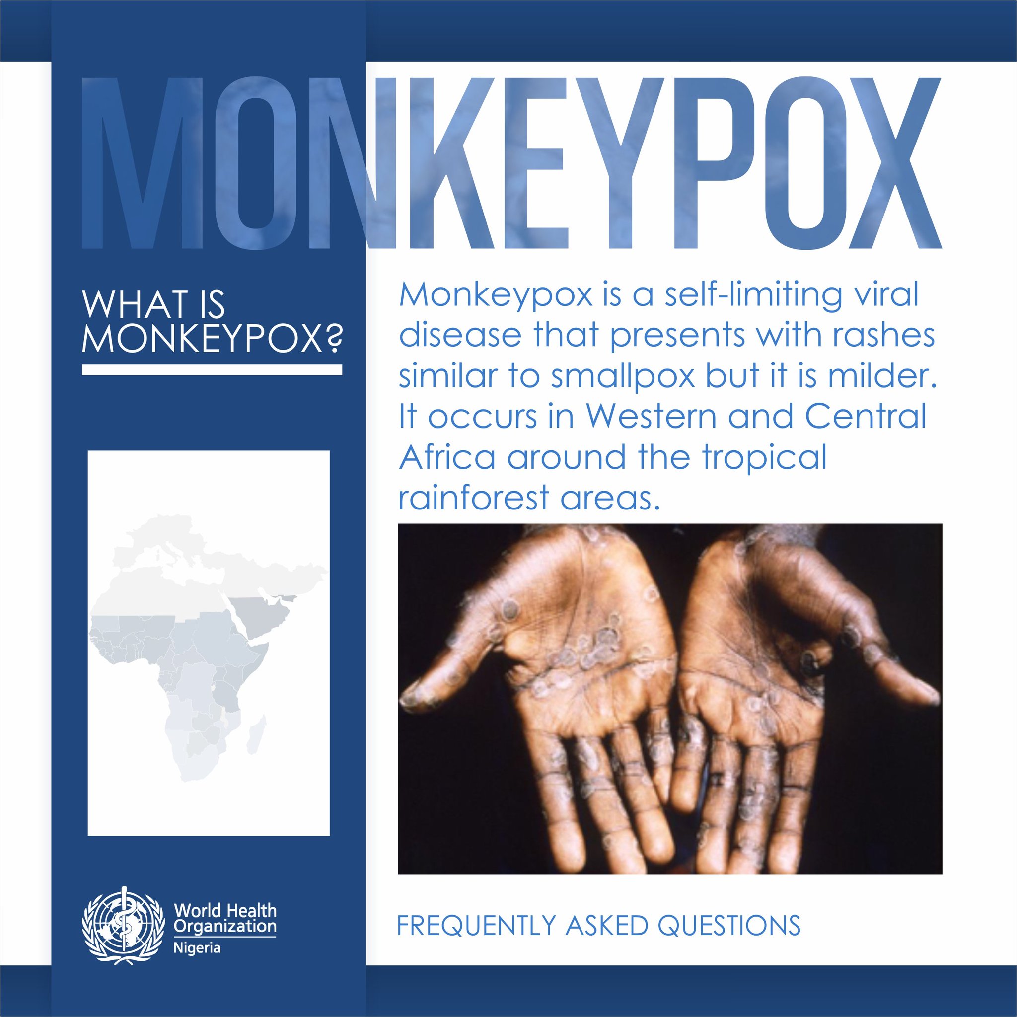 Who Nigeria Auf Twitter Faq What Is Monkeypox Monkeypox Is A Self Limiting Viral Disease That Presents With Rashes Similar To Smallpox But It Is Milder It Occurs In Western And Central Africa