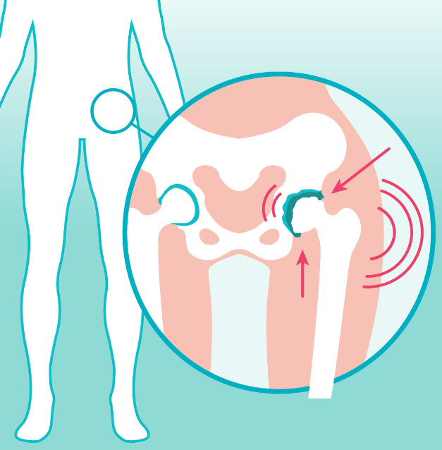 #Artrose van de heup? Deze consultkaart kan arts en patiënt helpen om de mogelijkheden voor behandeling te bespreken: consultkaart.nl/wp-content/upl… …  #SamenBeslissen <a href="/PatientenNL/">Patiëntenfederatie</a>