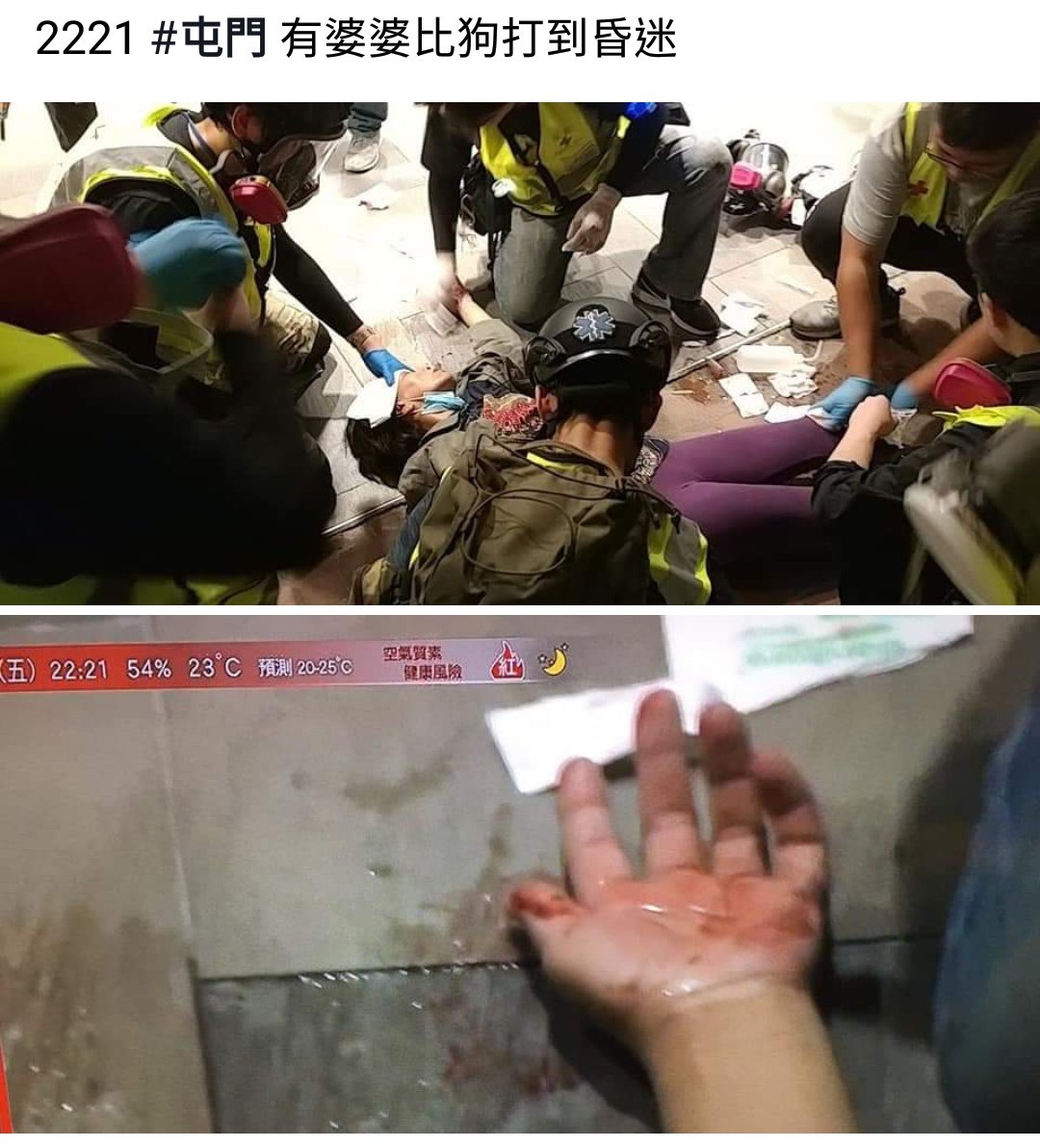 fb消息指屯門黑警推進期間與一婆婆發生衝突，婆婆比狗打到流血昏迷
A granny is hit into coma by #HongKongPolice during the police operation in Tuen Mun.
#HongKong