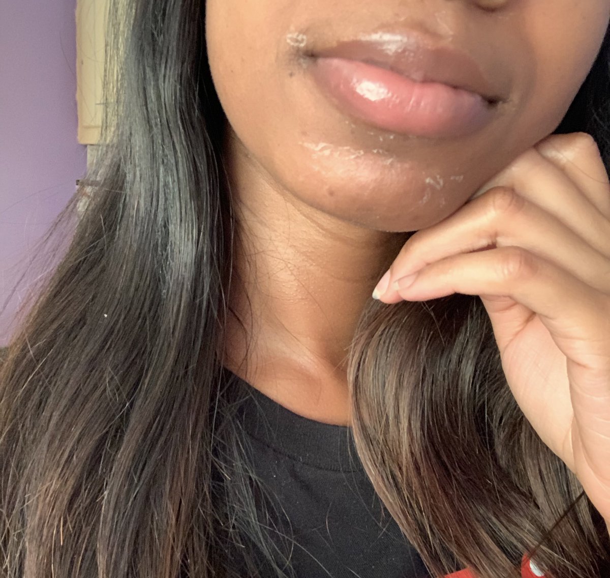 NolaMarianna's tweet photo. The first hint of peeling began 24 hours after the TCA application. Then woke up this morning to see it in full motion 🙌🏾🙌🏾🙌🏾 #tcapeel @beaskinclinic https://t.co/17EOsJwAUK