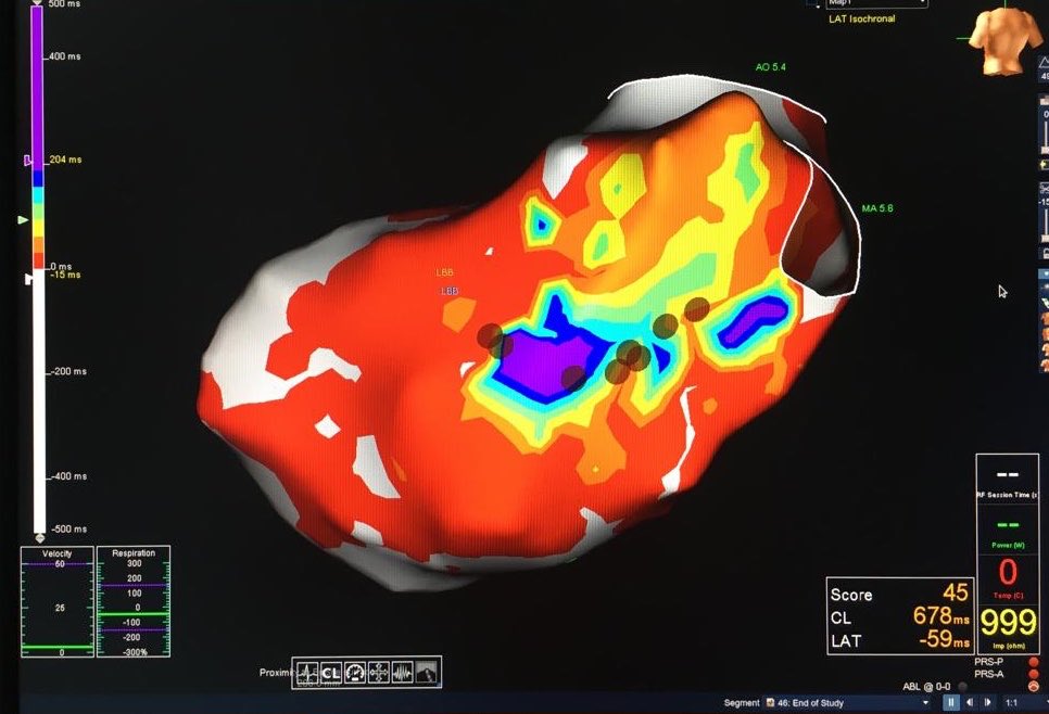 MDTolgaAksu's tweet photo. My first ILAM mapping attempt during sinus. Recurrent ICD shocks due to fast VT. VT was not tolerable. So, we decided to map during sinus. Brown dots were used to indicate localization of isthmus which were seen in Figure 2. https://t.co/6mmMlurrbb