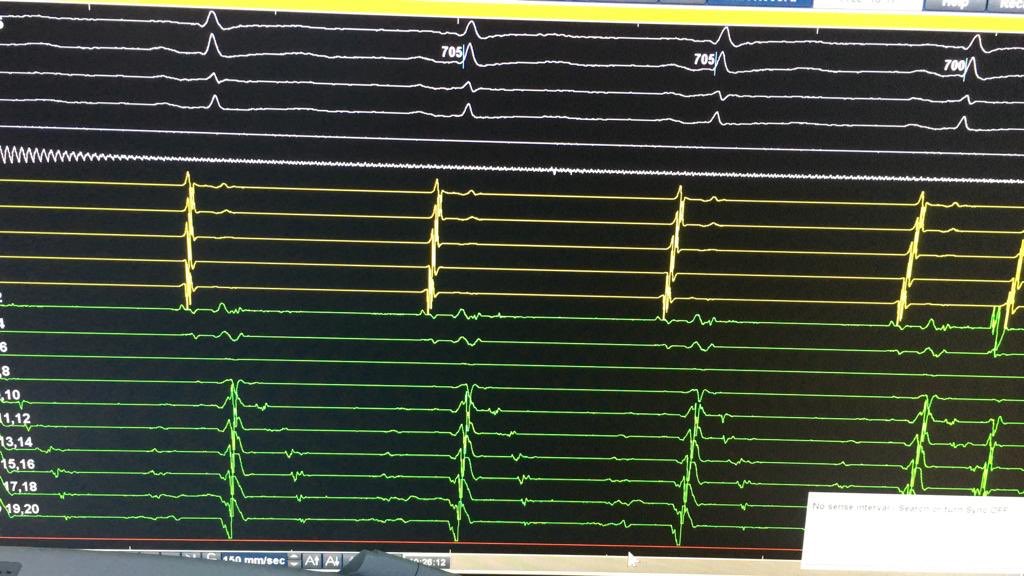 My first ILAM mapping attempt during sinus. Recurrent ICD shocks due to fast VT. VT was not tolerable. So, we decided to map during sinus. Brown dots were used to indicate localization of isthmus which were seen in Figure 2.