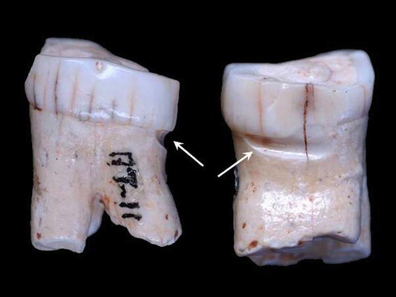 #FossilFriday Molar AT-11 belonged to a hominin from Sima de los Huesos #Atapuerca who used toothpick to alleviate periodontitis 430,000 years ago.