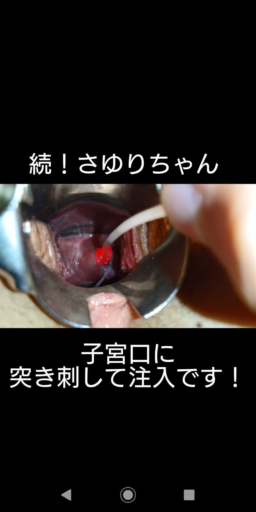 子宮口　クスコ 