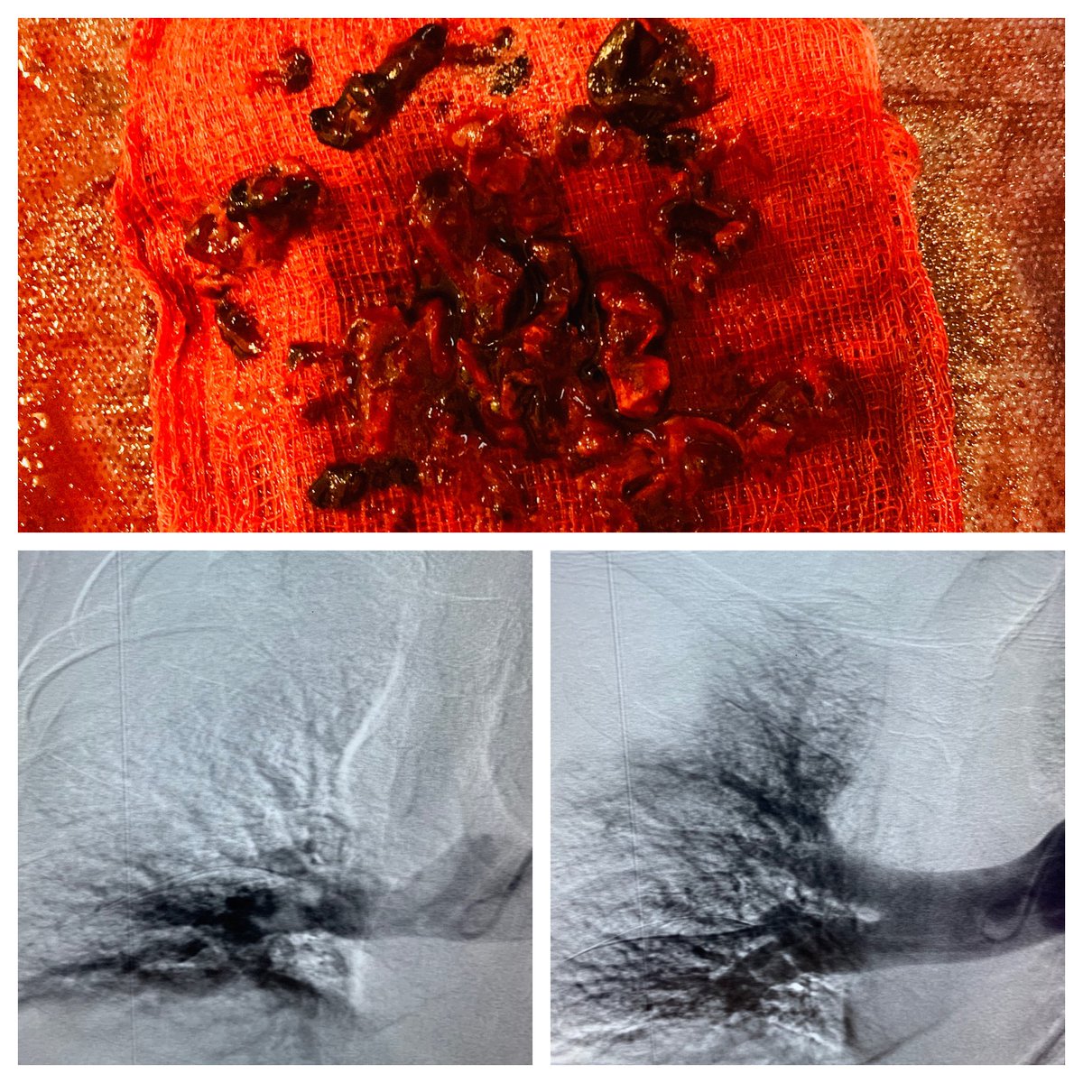 Noor Ahmad (@noorahmadmd) on Twitter photo Another great result with <a href="/InariMedical/">Inari, now part of Stryker</a> Flowtriever today. #No TPA needed and drastic reduction of PA pressures immediately on the table. <a href="/PERTConsortium/">The PERT Consortium®</a> <a href="/akhileshsistaMD/">Akhilesh Sista</a> <a href="/RonaldWinokurMD/">Ronald Winokur, MD, FSIR, FAVLS, RPVI</a> <a href="/SIRspecialists/">Society of Interventional Radiology</a> <a href="/amitramjitMD/">Amit Ramjit</a> <a href="/JesseChenMD/">Jesse Chen</a> <a href="/jameshorowitzmd/">James Horowitz</a> <a href="/ShaolinIR/">Staten Island University VIR</a> <a href="/MountSinaiIR/">Mount Sinai IR</a> Another great result with <a href="/InariMedical/">Inari, now part of Stryker</a> Flowtriever today. #No TPA needed and drastic reduction of PA pressures immediately on the table. <a href="/PERTConsortium/">The PERT Consortium®</a> <a href="/akhileshsistaMD/">Akhilesh Sista</a> <a href="/RonaldWinokurMD/">Ronald Winokur, MD, FSIR, FAVLS, RPVI</a> <a href="/SIRspecialists/">Society of Interventional Radiology</a> <a href="/amitramjitMD/">Amit Ramjit</a> <a href="/JesseChenMD/">Jesse Chen</a> <a href="/jameshorowitzmd/">James Horowitz</a> <a href="/ShaolinIR/">Staten Island University VIR</a> <a href="/MountSinaiIR/">Mount Sinai IR</a>