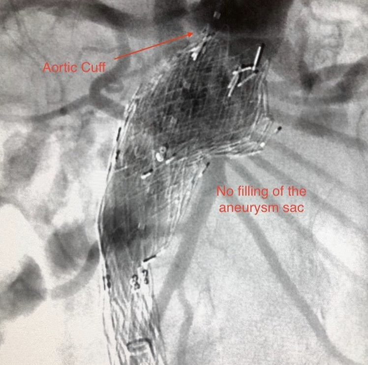 This patient presented with a symptomatic type 1a endoleak after EVAR. The patient was treated with aortic cuffs to bridge to the renal arteries. The second picture shows the absence of contrast in the aneurysm sac and adequate seal at the renal arteries. #vascularsurgery #EVAR