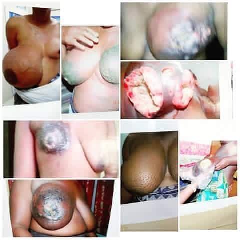 Lytevents1's tweet photo. Have you checked your boobs? This is breast cancer at it last stage. The pink month is gradually coming to an end. Be mindful of breast cancer.
#lytevents
#Accra
#accrafloods
#thisistemafestival
#ThisIsTema https://t.co/KRAd3VhMvT