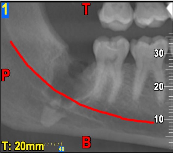 inst_guirado's tweet photo. Fractura radicular de cordal situado externo a la mandibula por lingual. Adquirido con equipo NewTom 5G XL. 
#dental #odontologia #imagenparaeldiagnostico #radiologia #radiology #radiographer #medicine #tc #cbct https://t.co/zLj9X73Ci5