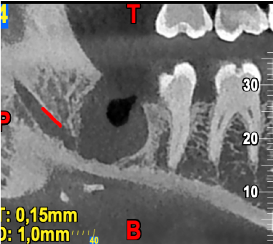 inst_guirado's tweet photo. Fractura radicular de cordal situado externo a la mandibula por lingual. Adquirido con equipo NewTom 5G XL. 
#dental #odontologia #imagenparaeldiagnostico #radiologia #radiology #radiographer #medicine #tc #cbct https://t.co/zLj9X73Ci5