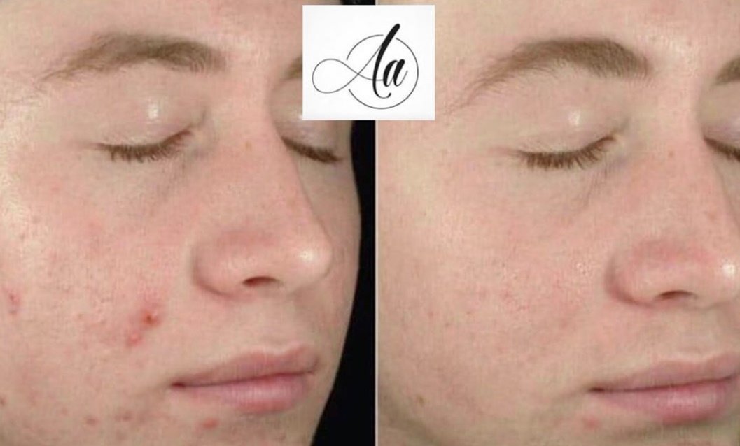 Welcome to Artful Aesthetics by Rebecca H 💚 New on Go Local UK

Registered Nurse Presciber. Trained in anti wrinkle injections and fillers by Skin Viva. Obagi skincare &amp;. Eyelash enhancement treatment.
👁💋

golocaluk.com/brand/artful-a…

#eatlocal #shoplocal #buylocal #golocaluk