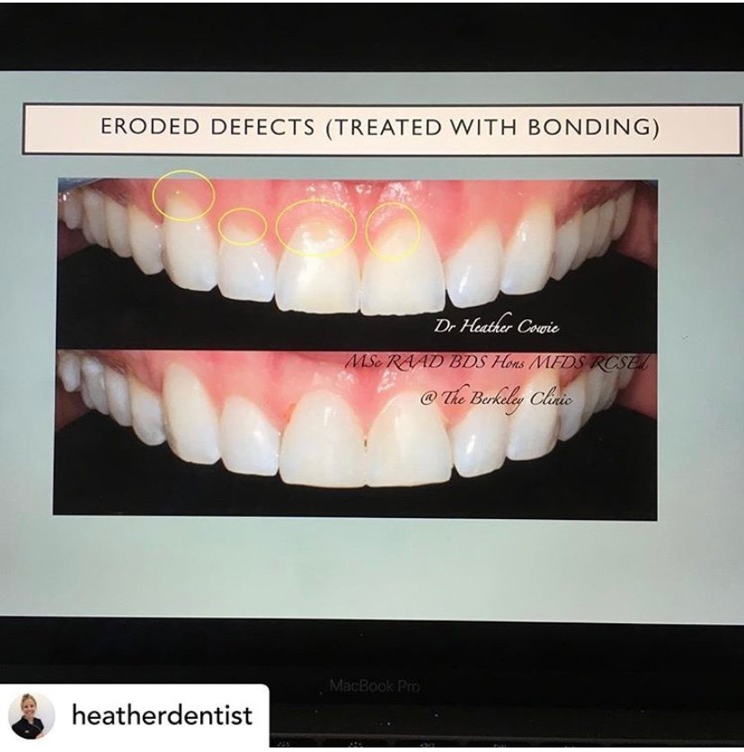 Dental erosion is a common problem caused by acid (often carbonated drinks and juices) that weaken the enamel making it soft ..and easy to abrade or wear away.This can make teeth sensitive, thin and chipped. #Dental erosion can be easily treated #bonding #dentist #berkeleyclinic