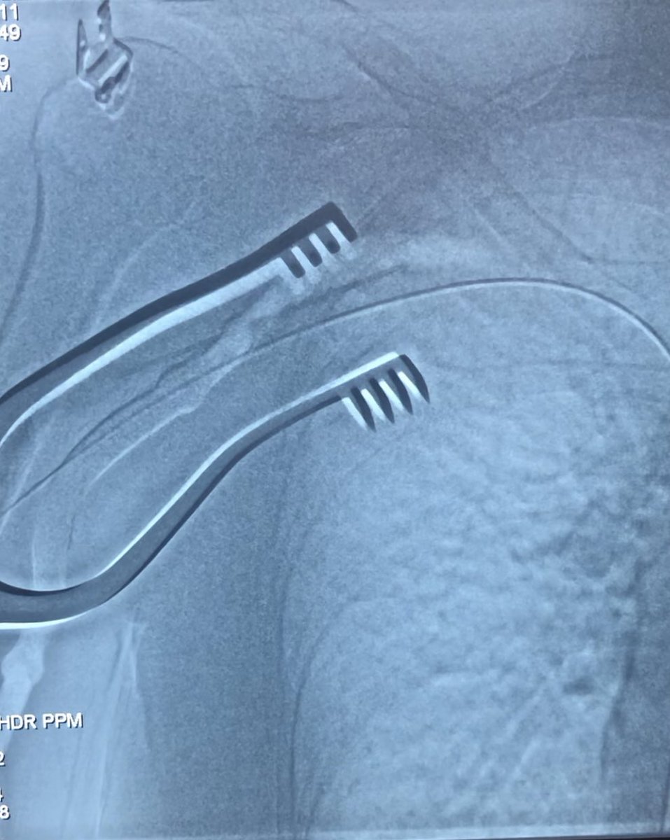 VivekMutha3's tweet photo. Overlay of venogram on fluoroscopy shows real time position of needle in relation to vein ( prior shot)  #pacemaker #EPpeeps #cardiotwitter https://t.co/yhxJdwpbVp