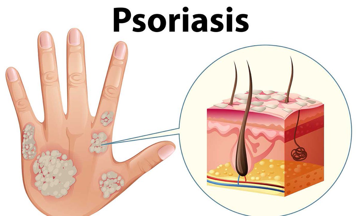 laboticadetete's tweet photo. 📌
Fuente: @accionpsoriasis
#WPD19 #worldpsoriasisday #letsgetconneted #psoriasis #díamundialdelapsoriasis https://t.co/oCM8kWwyCt