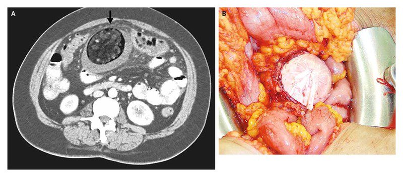 NEJM's tweet photo. From the #NEJMArchive: An Intraabdominal Cyst https://t.co/BZERPn1qPE https://t.co/qFUeRVLkdn