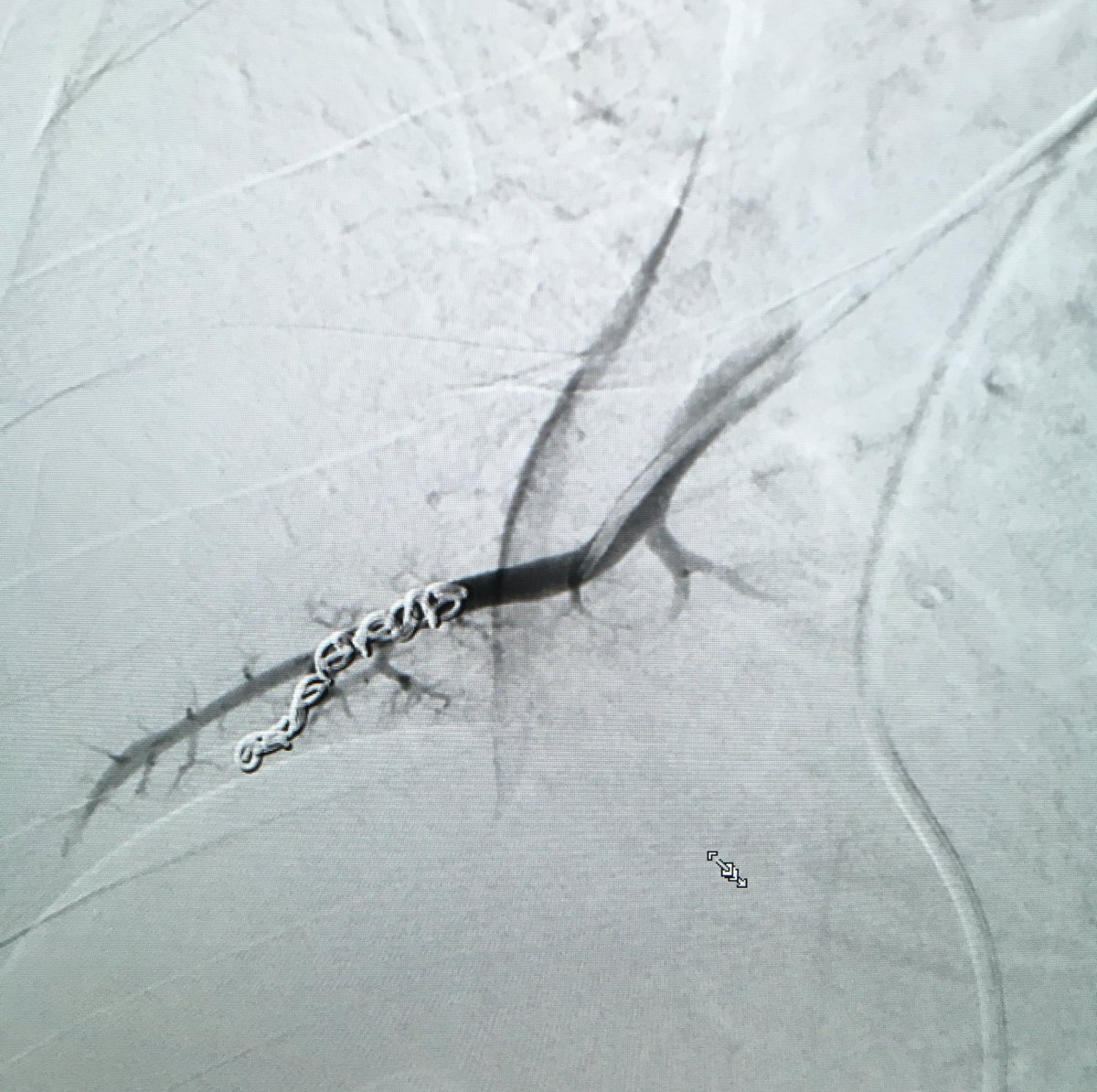 Embolization of pulmonary AVM with <a href="/RMargau/">Ryan Margau</a>. First case <a href="/NYGH_News/">North York General</a> went smoothly thanks to great work by all members of the team! <a href="/Katie70842020/">Katie</a> <a href="/DrGeraldLegiehn/">Gerald Legiehn, MD</a> #VascularAnomalies