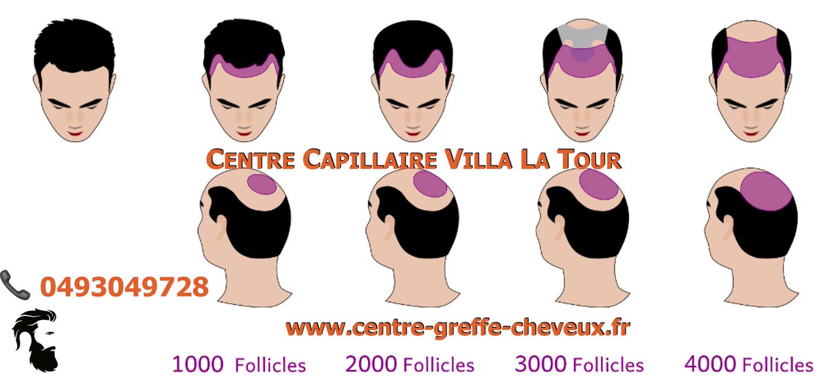 GreffeCheveux06's tweet photo. De combien de greffons avez-vous besoin pour combler votre calvitie?
Pour le savoir, faites votre devis en ligne :
https://t.co/KpVoK5upVP

#greffecheveux #cliniquecheveux #cheveux #devis #devisenligne #cliniquevillalatour #nice06 https://t.co/rrEwpaem1R