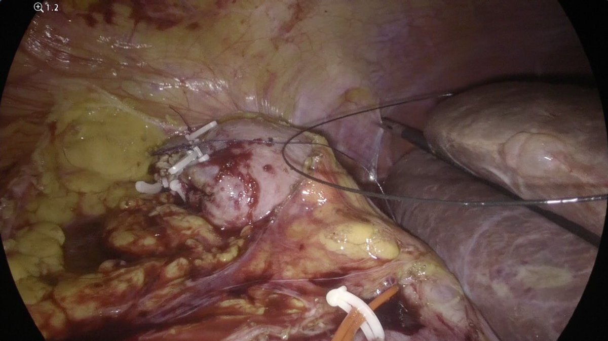 DPanarelloMD's tweet photo. Second case of #laparoscopic partial nephrectomy in complete spinal-peridural anesthesia using @olympus 4k laparoscopic camera. Is it a new way to reduce #perioperative complications? #Ospedaleevangelicointernazionale #genova #urology @TimossiL https://t.co/ynvh0pzZVD