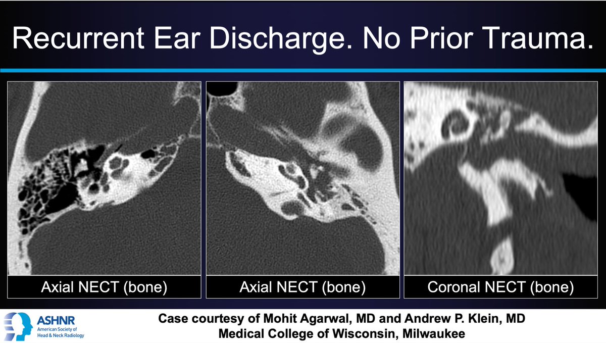 ASHNRSociety's tweet photo. #ASHNRCOTW #79: Recurrent ear discharge, no trauma. Findings? Dx? Thx Drs. @MohitAgNeurorad &amp; Klein for case! #ASHNR20

Answer w/ appropriate GIF only -- stay professional &amp; don't spoil it!

@callyrobs @DShatzkes @rhwiggins @CDP_Rad @nakoontz @cmtomblinson @TheASNR @ESHNRSociety https://t.co/Fx2hBlflCC