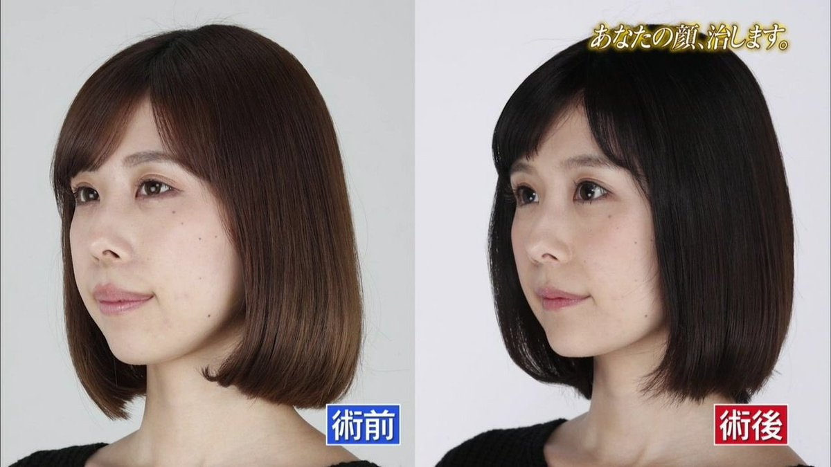 野口紗生 平凡素人 W 整形にはどちらかと言えば反対派でしたが 有村藍里さんの整形 形成 手術を見てから考えが変わりました だって人生にとって 笑う ことって大切でしょ それに人生観が明るく変化するならそれで良いじゃん 整形万歳