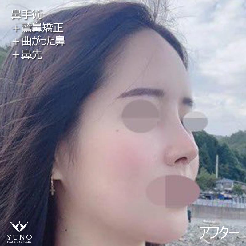 ユノ美容外科 I 公式 على تويتر 鷲鼻 を持っている方なら特に横の顔が気になりますよね 今回の患者様は滑らかでスリムな鼻先で顔まで綺麗に見えます コンプレックスの鼻穴も綺麗になりました お問い合わせline Psyuno Psyuno2 鷲鼻矯正 鼻筋 鼻先 曲がっ ユノ美容外科 I 公式 على تويتر 鷲鼻 を持っている方なら特に横の顔が気になりますよね 今回の患者様は滑らかでスリムな鼻先で顔まで綺麗に見えます コンプレックスの鼻穴も綺麗になりました お問い合わせline Psyuno Psyuno2 鷲鼻矯正 鼻筋 鼻先 曲がっ