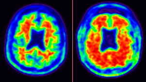 DementiasUK's tweet photo. Thanks to simultaneous PET-MR #imaging techniques scientists @drcionucl @MRCLHA are seeing the workings of the brain in greater detail than ever before #brainhealth #healthresearch #dementia #insight46 @KingsIoPPN @The_MRC @UoM_Imaging
https://t.co/lgo9Mc8RDO @jmschott https://t.co/RmqMEmrZ2S