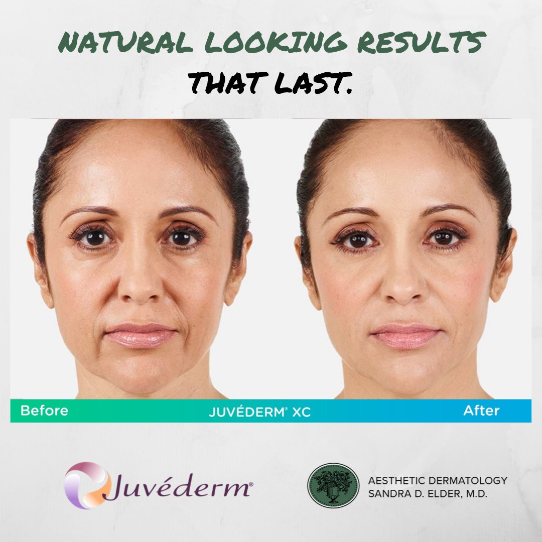 AestheticDerma's tweet photo. Can't get enough #fillers that last? Try Juvéderm, proven to stay natural &amp; healthy so you can look your best!

Book a consultation today:

☎️(856) 596-3393
📩Info@DrSandraElder.com

#LoveYourself #Selfcare #Skincare #Beauty #Love #Wellness #Health #TreatYoSelf #Beautiful https://t.co/TJ9zt14bdh