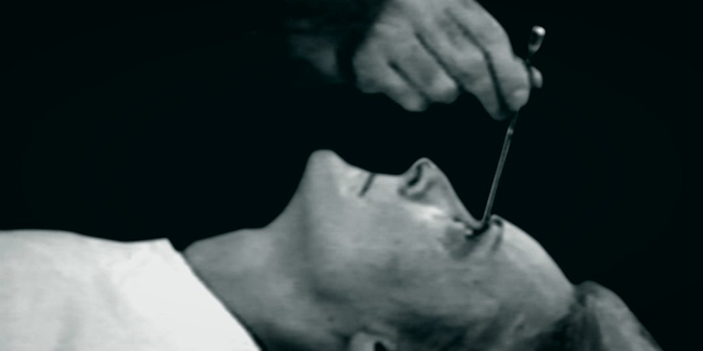 What is a lobotomy how was it performed 50 off