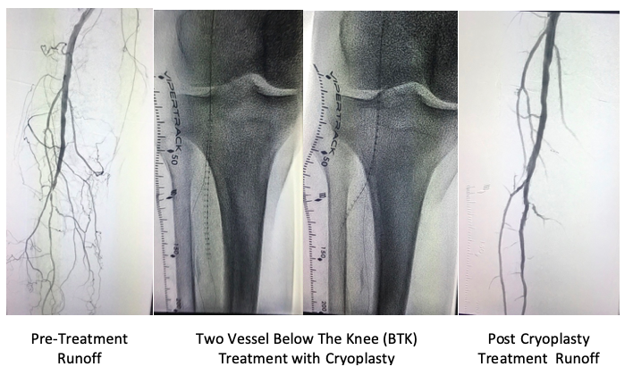 nucryo's tweet photo. Great PolarCath @Nucryo case by Dr. James Kong @TCHheart.   Excellent case supported by data via the PolarCath BTK Chill Study (https://t.co/1qEadLywrT).   #safe #data #costsavings #easeofuse #efficient #indicated https://t.co/NBeVmbZQYT