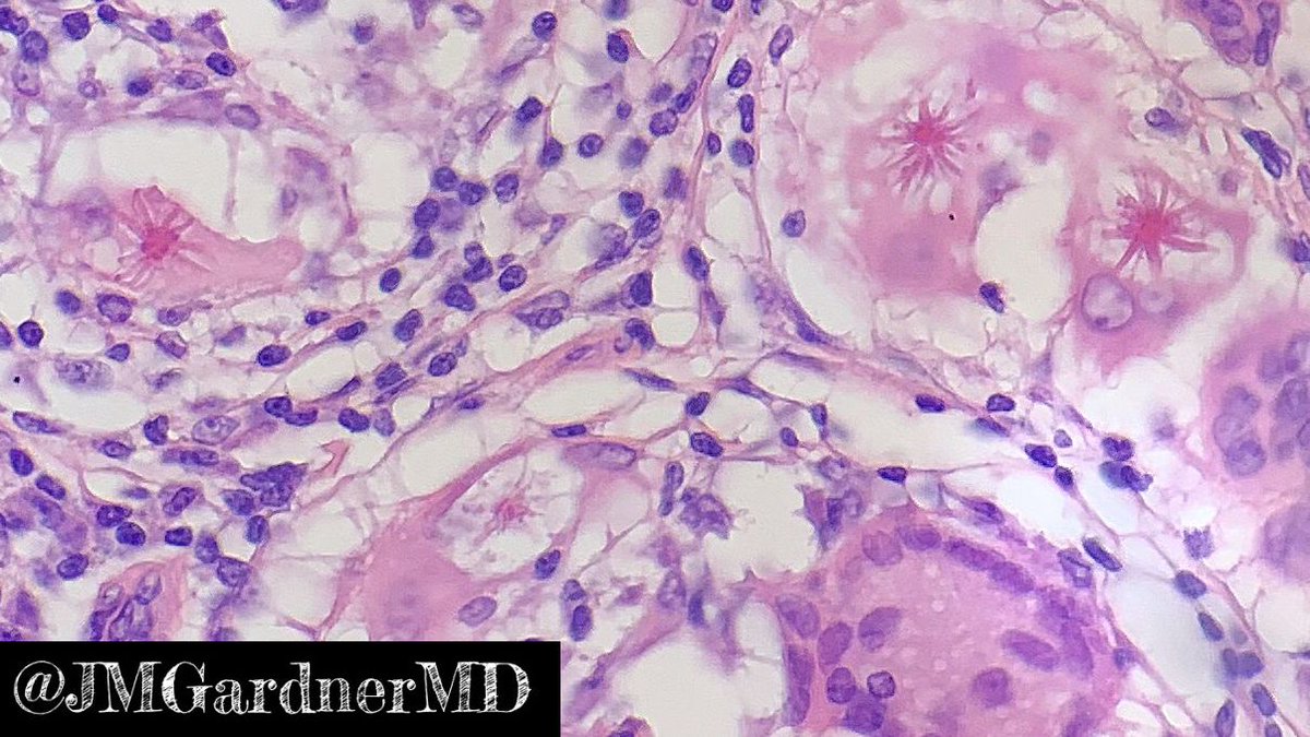 JMGardnerMD's tweet photo. What do you call a group of asteroid bodies? A constellation! πππThank you ladies & gentlemen! Iβll be here all week! Seriously though...4 in one field! π₯ #DadJoke #PathJoke #pathology https://t.co/vBkM0ofExa