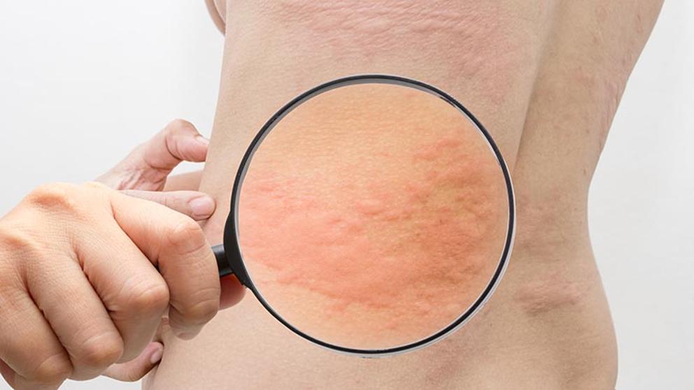 Urticaria por frío: factores de riesgo y prevención bit.ly/2N68gwP #dermatologia #urlticaria #prevencion