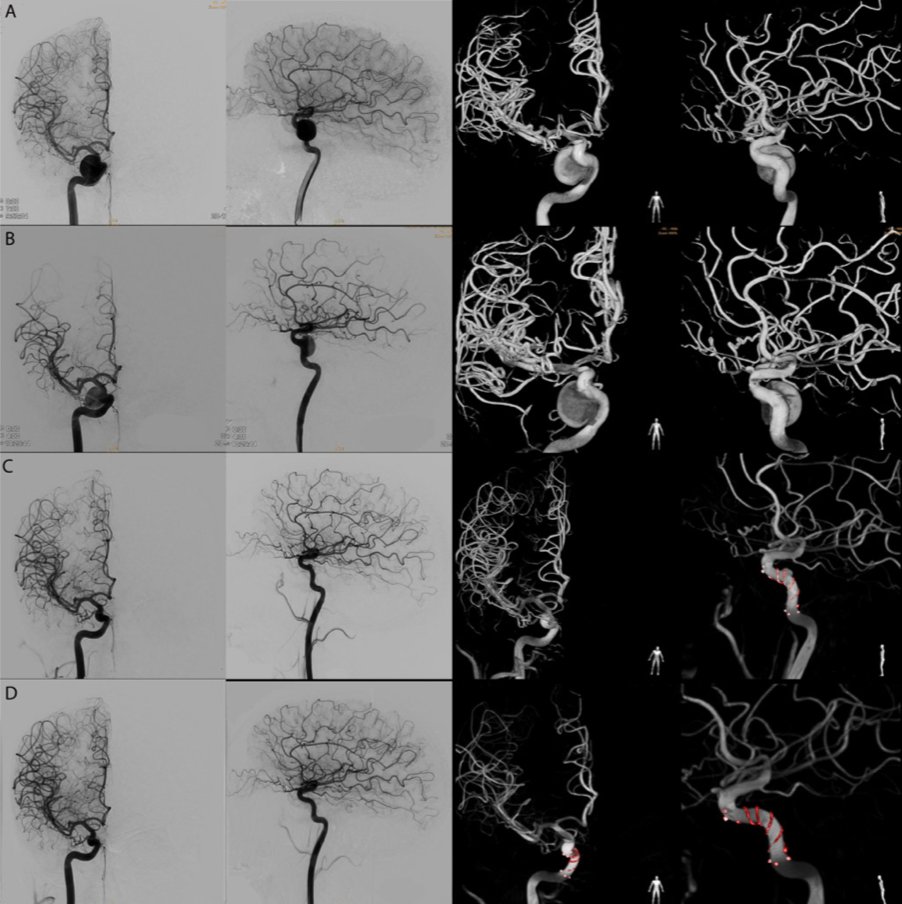 Guimaraens et al: Efficacy and safety of FRED for the treatment of aneurysms. ow.ly/NLWy50wWv37
