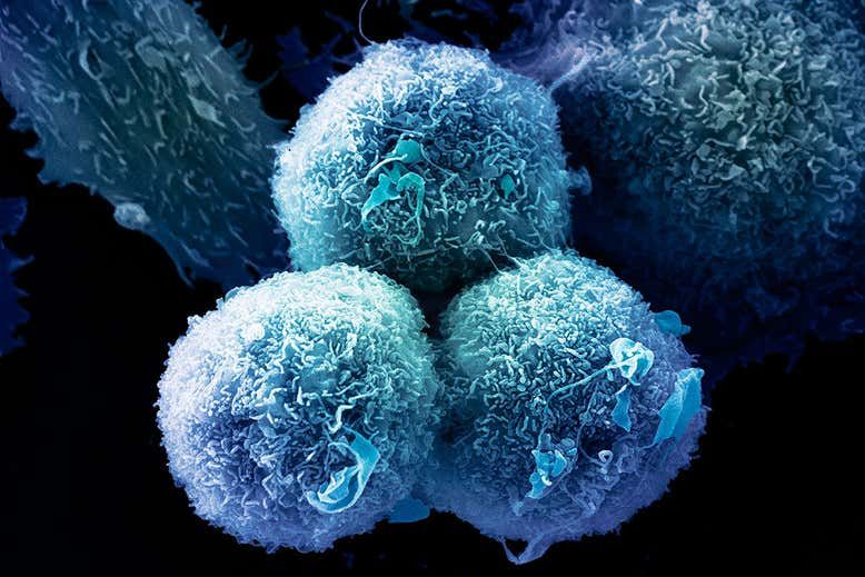 IRISBioTech's tweet photo. Experimental cancer drug that targets gene mutation can shrink tumors:
The team also studied the effects of the drug on four people with non-small-cell lung carcinoma and their tumors shrunk. 
https://t.co/Aq81r2Hhtw
#Cancer https://t.co/cvVDSfYvjI