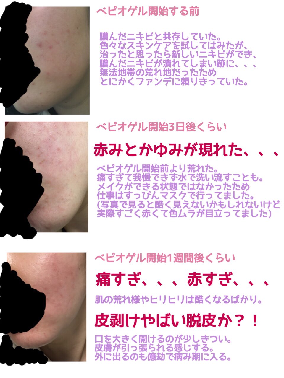 ご醜傷様ちゃん ベピオゲルに関する質問が多いので 私のベピオゲル 奮闘記まとめました これみたら分かると思うんですけど 死ぬほど辛かったです 全部の写真iphoneの内蔵カメラで撮りました 写真より実物の方が酷かったかも 軽い気持ちで ベピオゲル塗る