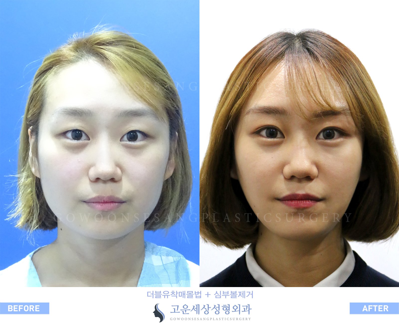ゴウンセサン美容整形 ダブル癒着埋没法 Lline T Co Zet98l0lel オルチャン ソウル 韓国 カンナム ダブル 癒着 埋没法 自然癒着 二重 一重 目頭切開 目の整形 目尻切開 涙袋 タレ目 瞼 まぶた ナチュラル 小切開法 全
