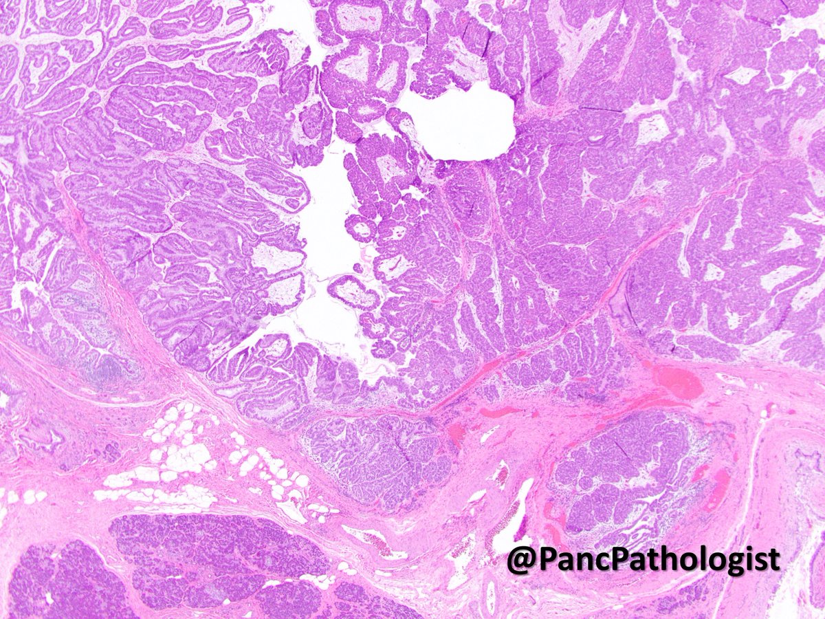 2/n Intraductal Oncocytic Papillary Neoplasms (IOPNs) are rare, but unique neoplasms that can occur in both the pancreas and bile duct. IOPNs are characterized by flat-to-papillary epithelium with abundant, eosinophilic cytoplasm and a prominent nucleolus.  #GIPath  #Pathology