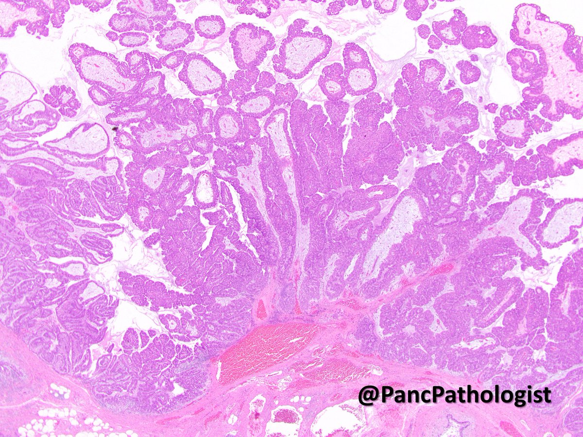 2/n Intraductal Oncocytic Papillary Neoplasms (IOPNs) are rare, but unique neoplasms that can occur in both the pancreas and bile duct. IOPNs are characterized by flat-to-papillary epithelium with abundant, eosinophilic cytoplasm and a prominent nucleolus.  #GIPath  #Pathology