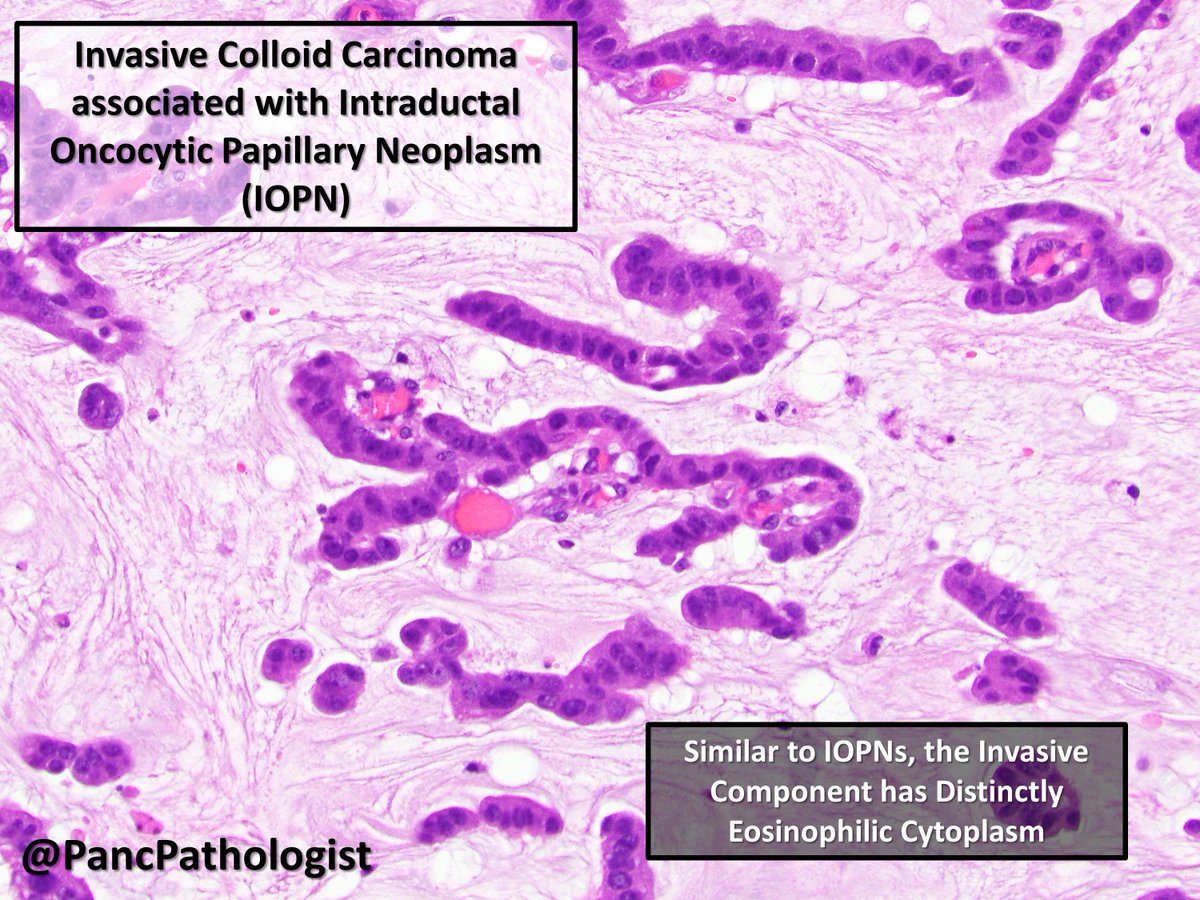 3/n IOPNs are cystic precursor neoplasms to both  #PancreaticCancer and  #Cholangiocarcinoma.  #Pathology  #PancreaticPath  #BileDuctPath  #GIPath  https://tinyurl.com/y2qehyvq 