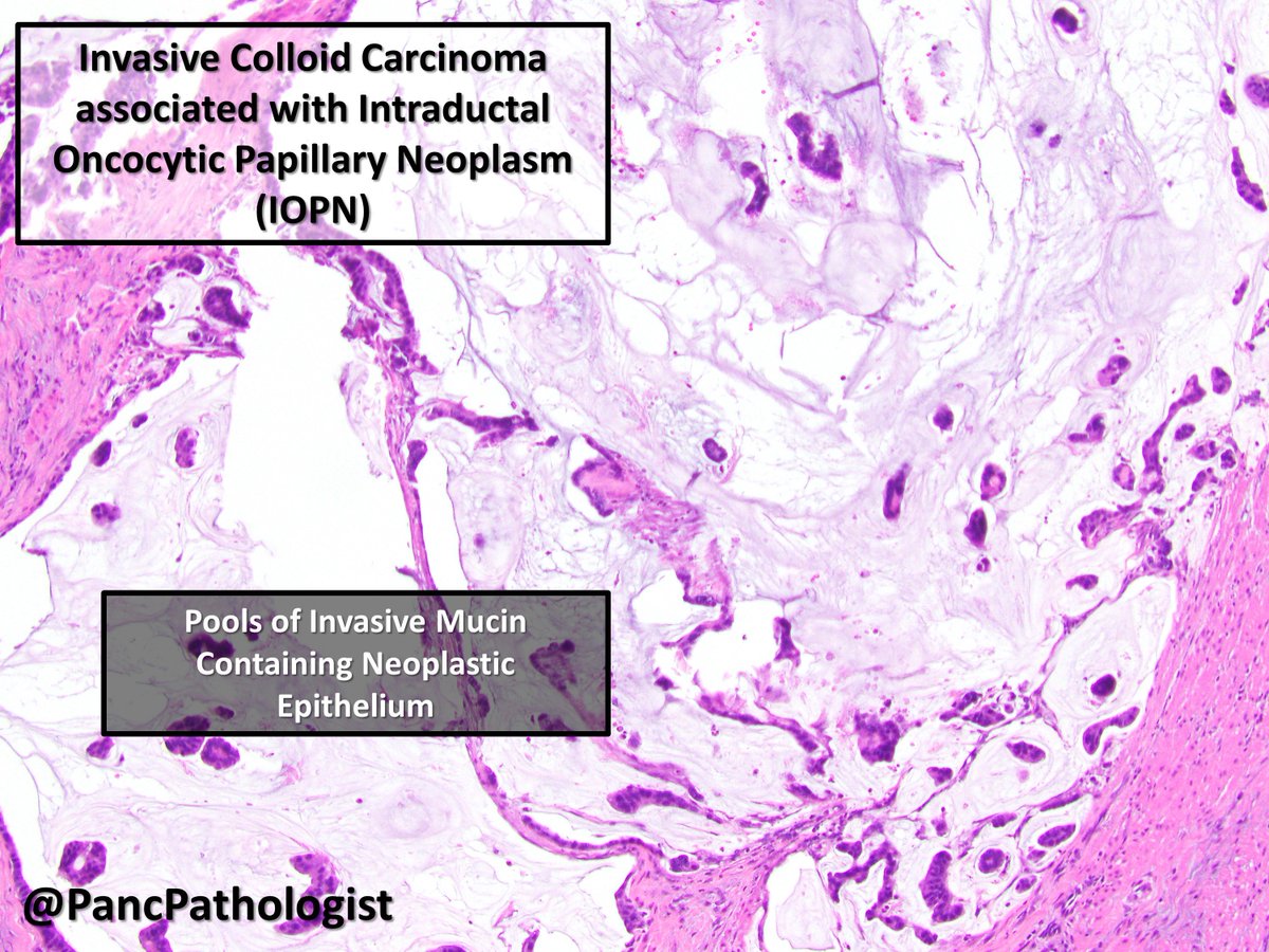 3/n IOPNs are cystic precursor neoplasms to both  #PancreaticCancer and  #Cholangiocarcinoma.  #Pathology  #PancreaticPath  #BileDuctPath  #GIPath  https://tinyurl.com/y2qehyvq 