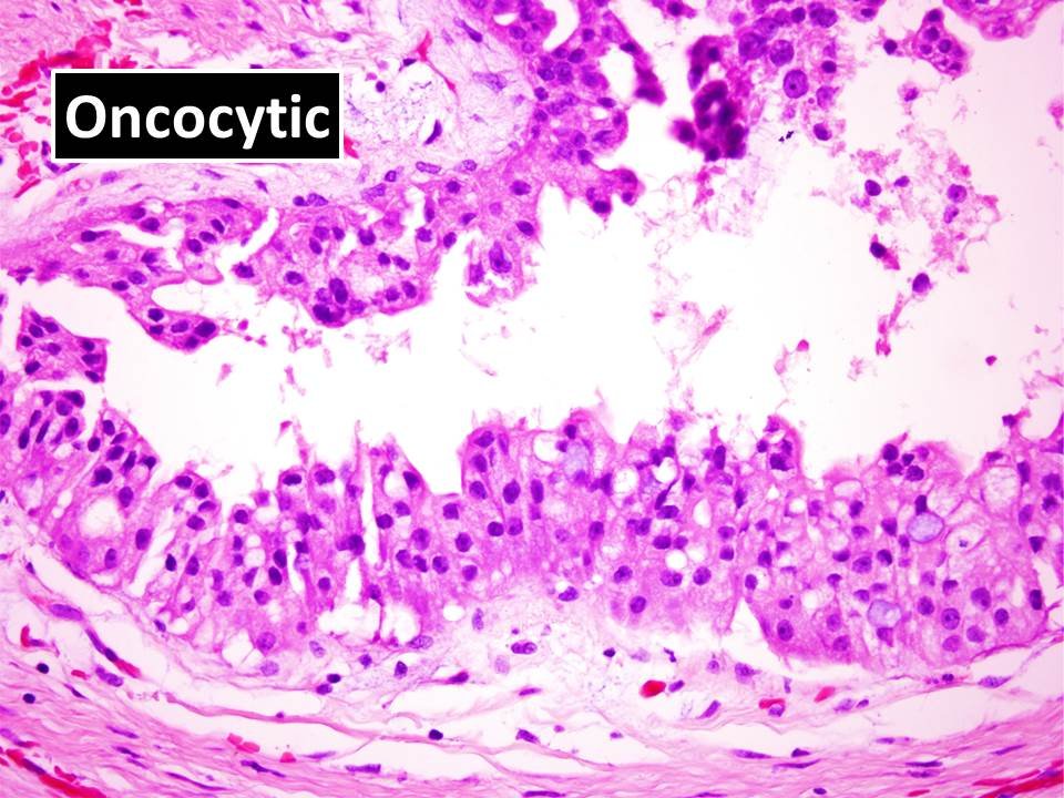 4/n Previously, pancreatic IOPNs (2010 WHO) were classified as a subtype of Intraductal Papillary Mucinous Neoplasms (IPMNs), which is a common  #PancreaticCyst and frequently characterized by genomic alterations involving KRAS and GNAS.  #GIPath  #PancreaticPath  #Pathology