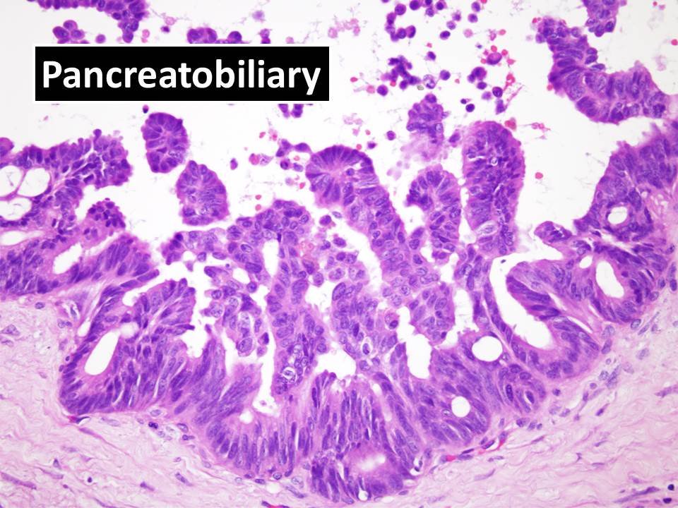 4/n Previously, pancreatic IOPNs (2010 WHO) were classified as a subtype of Intraductal Papillary Mucinous Neoplasms (IPMNs), which is a common  #PancreaticCyst and frequently characterized by genomic alterations involving KRAS and GNAS.  #GIPath  #PancreaticPath  #Pathology